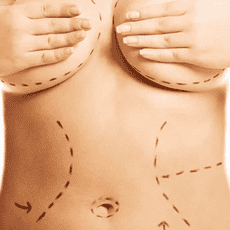 Great Savings Mommy Makeover Package in Tijuana, Mexico