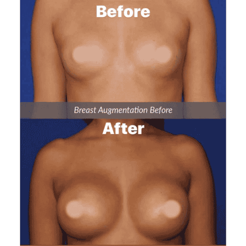 Low Cost Breast Augmentation in Reynosa, Mexico - $3,500
