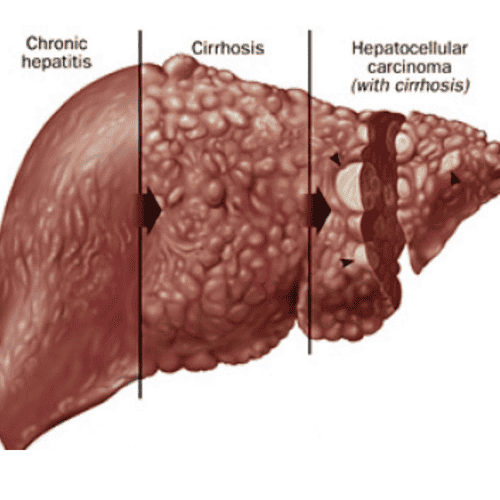 Topmost Fetal Stem Cell Therapy for Liver Cirrhosis in Kiev, Ukraine