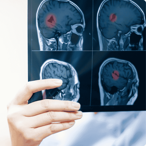 Multiple Sclerosis Stem Cell Package in Ukraine