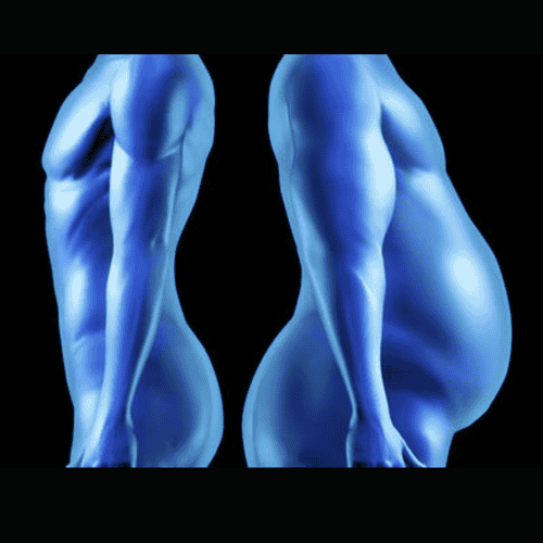 Gastric Sleeve Plication Surgery (LGCP) in Mexico