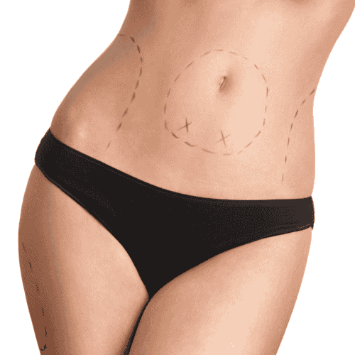 Best Tummy Tuck in the Dominican Republic - $3200