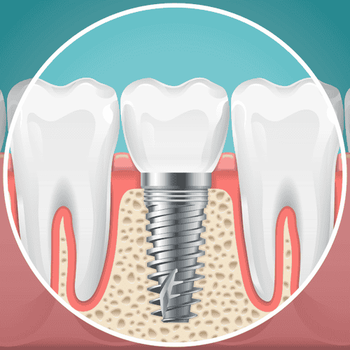 Dental Implants in Colombia - Affordable Tooth Replacement