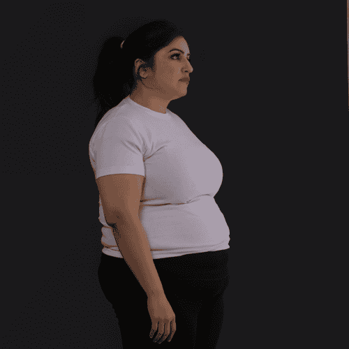 Best Roux-en-Y Gastric Bypass Revision Surgery in Tijuana, Mexico