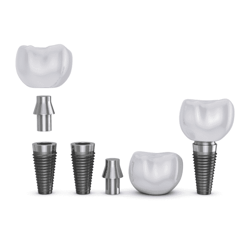 Best Package for Dental Implant in Tijuana, Mexico