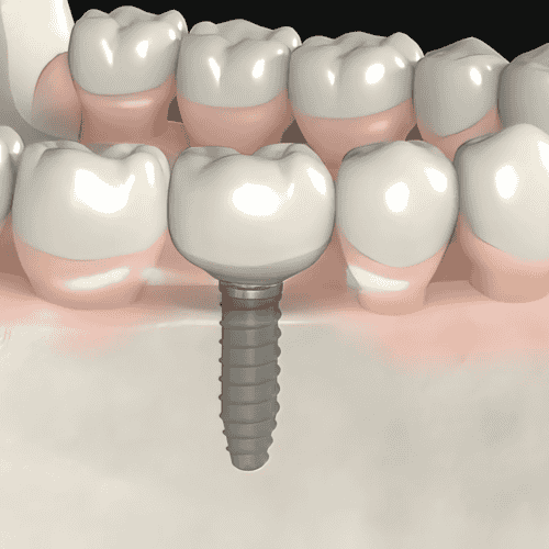 Dental Implants in Los Algodones, Mexico - Package Price $750