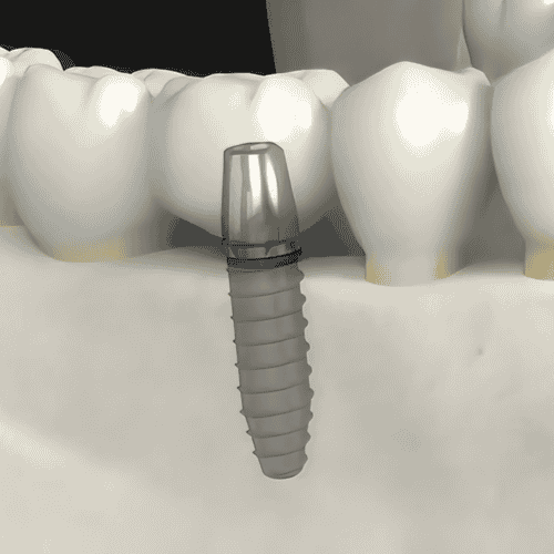 Best Dental Implants in Istanbul Turkey Costs