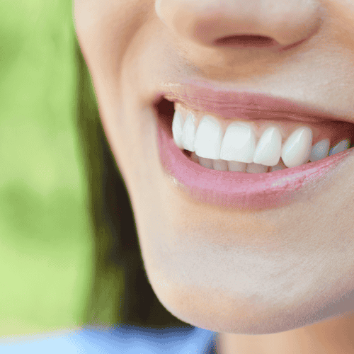 Effective Package for Dental Veneers in San Jose, Costa Rica