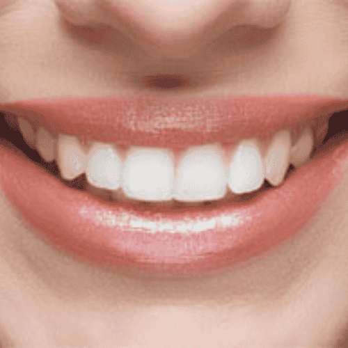 All on 6 Dental Implants Package in Cancun, Mexico by NEO Dental Group