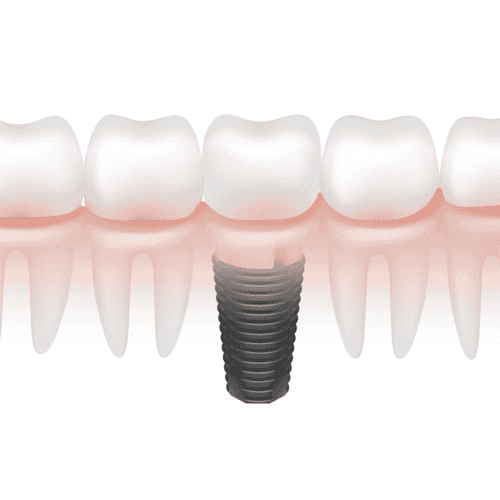 Cheap Package for Dental Implants in Cancun, Mexico