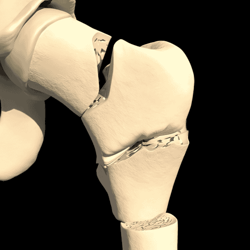 Arthroscopic Joint Surgery in Puerto Vallarta Mexico