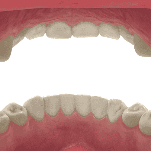 Effective Package for Dental Crown in Medellin, Colombia