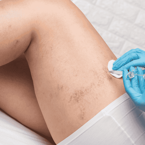 Permanent Spider Vein Removal in Costa Rica: Affordable, Effective, and Expert Care