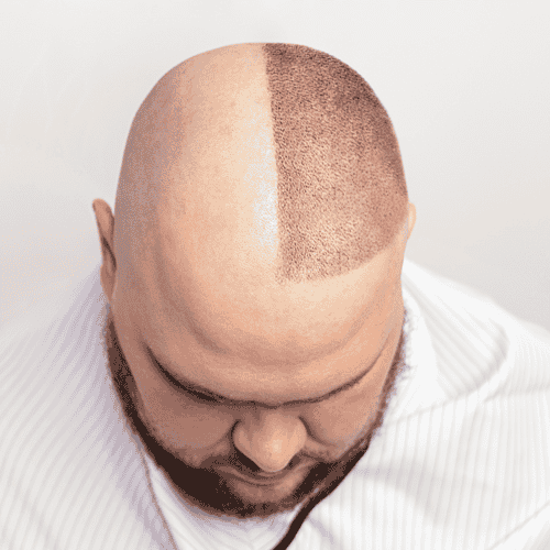 Stem Cell Treatment for Hair Transplant Package in Kuala Lumpur, Malaysia by FirstCell