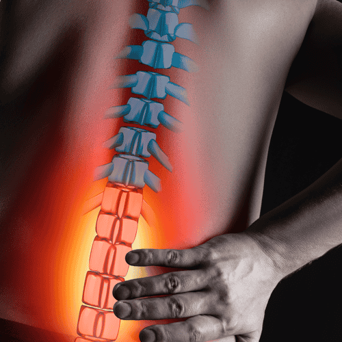 Epidural Neurolysis for Lumbar Stenosis in Milan, Italy