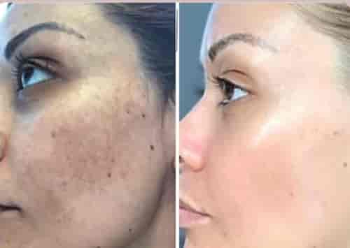 Skin Damage Treatment Program in Ukraine and Poland