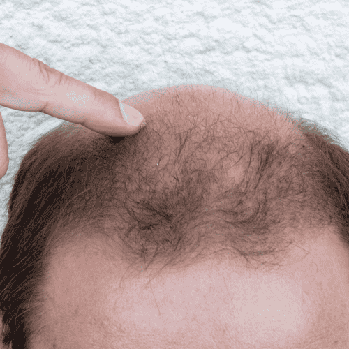 Platelet Rich Plasma for Hair Transplant in Mexico City, Mexico