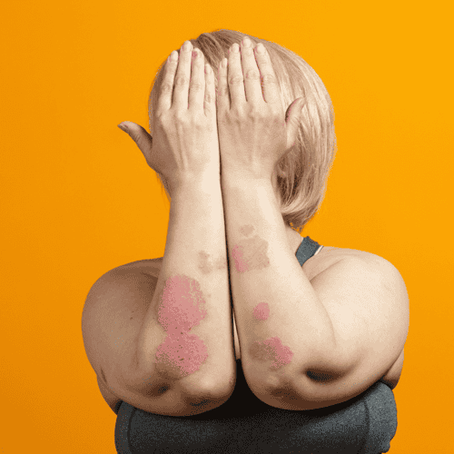 Stem Cell Therapy for Psoriasis Package in Tijuana, Mexico by CellsTime