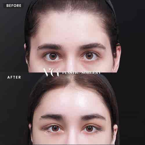 Forehead Lift Package in Seoul, South Korea by VG Plastic Surgery
