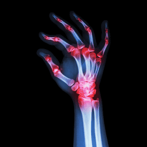 Top Rheumatoid Arthritis Stem Cell Treatment in Tijuana Mexico