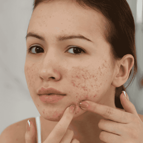 Affordable Stem Cell Mexico City Package for Scar Treatment by Dr. Ary Papadopulos