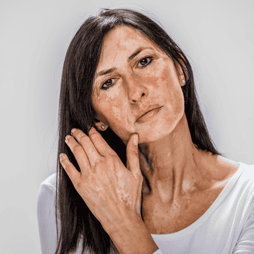 Treatment for Vitiligo