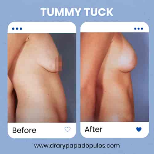 Tummy Tuck Package at Dr. Ary Papadopulos - Plastic Surgery in Mexico City, Mexico City, Mexico
