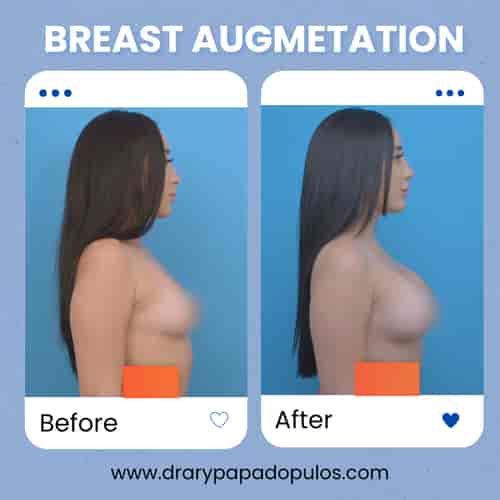 Breast Augmentation Mexico City – Affordable Package with Dr. Ary Papadopulos