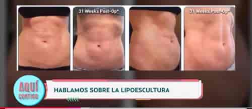 Mini Abdominoplasty Package at Dr. Ary Papadopulos - Plastic Surgery in Mexico City, Mexico City, Mexico
