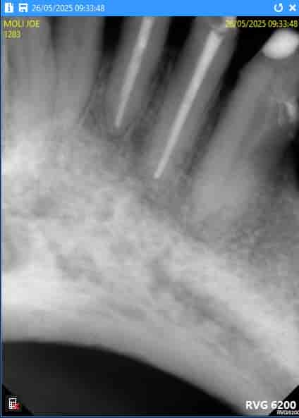 Root Canal and Build-up Package in Nuevo Progreso, Mexico