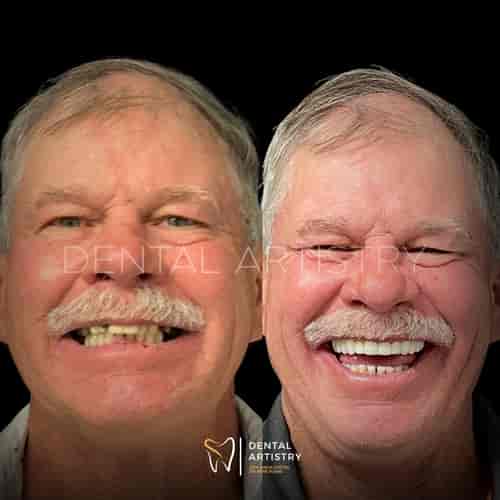 Affordable Dental Implants by Dental Artistry & World Dental Center in Nuevo Progreso, Mexico