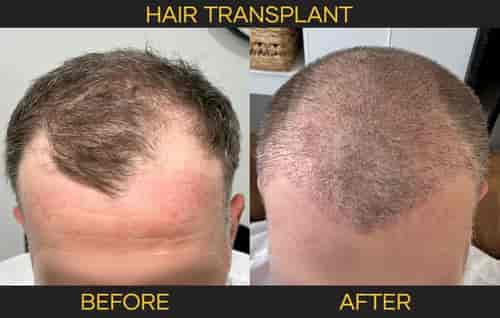 Cocoon's Hair Transplant  (FUE Hair Restoration)