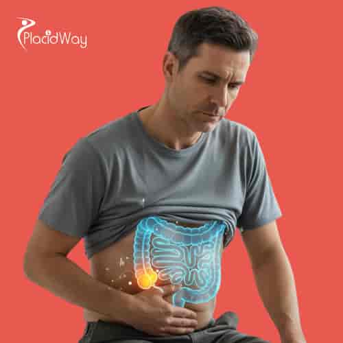 Alternative Colon Cancer Treatment Package with a Holistic Approach in Tijuana by ITC