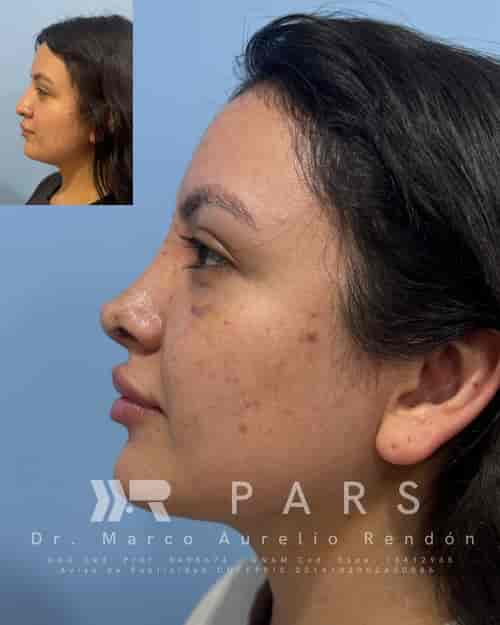 Nose Surgery Rhinoplasty Package at PARS - Plastic, Aesthetic & Reconstructive Surgery in Guadalajara, Mexico, Guadalajara, Mexico