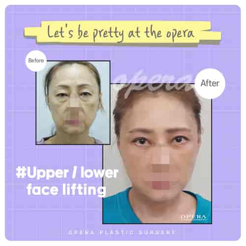 Face Lift Package at Opera Plastic Surgery in Gangnam, South Korea, Seoul, South Korea