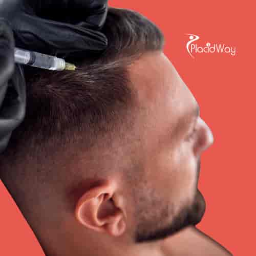 Non-Surgical Stem Cell Hair Restoration Mexico Package at CellsTime Guadalajara