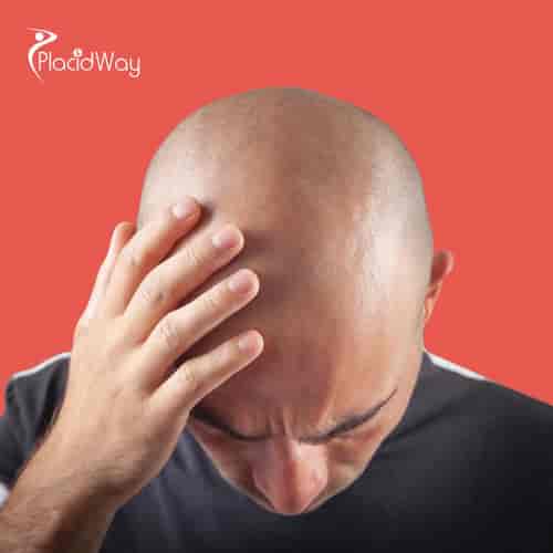 Alopecia Package at Zarina Clinic, Antwerp, Belgium