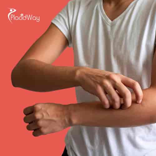 Stem Cell Therapy for Psoriatic Arthritis Package in Tijuana, Mexico by CellsTime Clinique