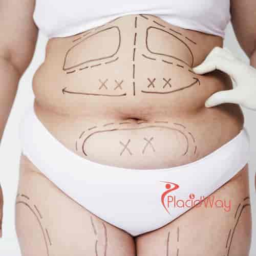 Comprehensive Mommy Makeover Package in Tijuana, Mexico by Dr. Israel Villalobos
