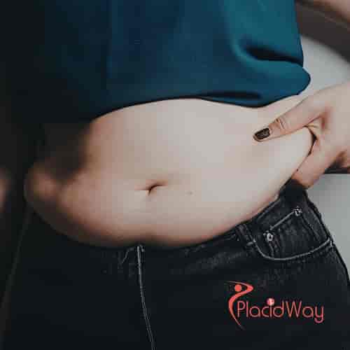 Advanced Tummy Tuck Surgery Package in Tijuana, Mexico by Dr. Villalobos