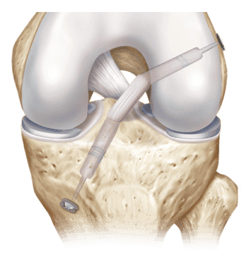 Arthroscopic Anterior Cruciate Ligament (ACL) Repair Surgery Package in Turkey