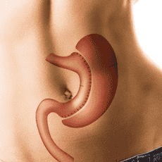 Affordable Gastric Sleeve Surgery Package in Tijuana, Mexico