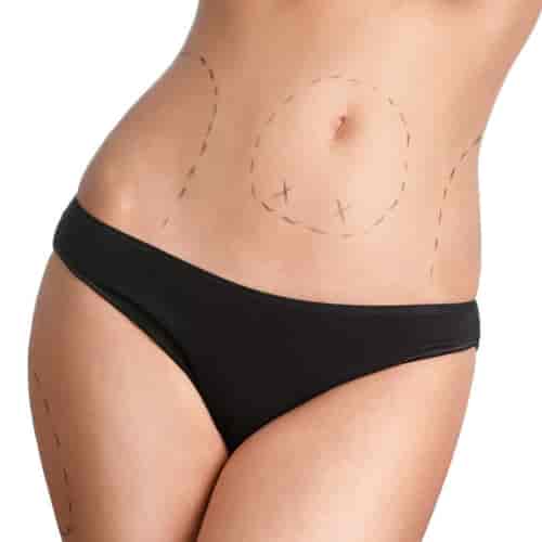 Best Tummy Tuck in the Dominican Republic -  $3200