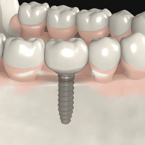 Dental Implants in Los Algodones, Mexico - Package Price $750