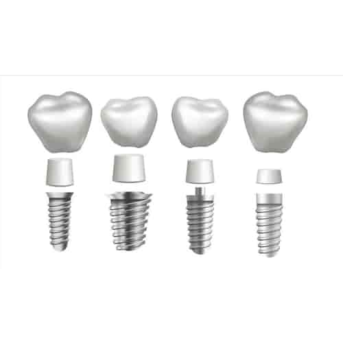 All on 4 Dental Implants in Puerto Vallarta, Mexico