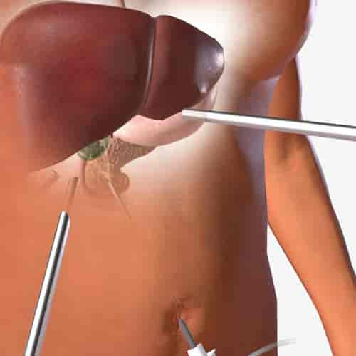 Laparoscopic Solutions