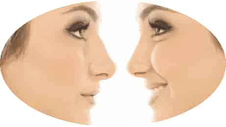 Nose Surgery Rhinoplasty Package at Cuba 