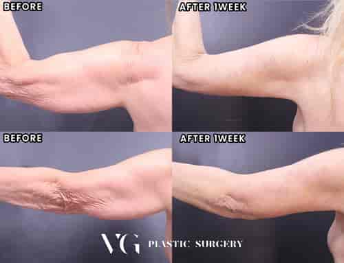 Arm Lift Package at VG Plastic Surgery in Seoul, South Korea