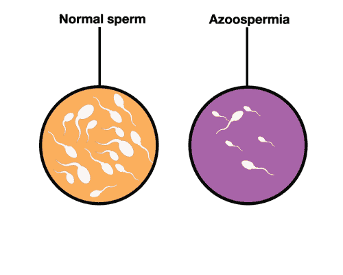 Azoospermia treatment program with stem cells