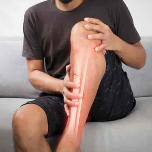 Stem Cell Therapy for Bone Fractures in Santo Domingo, Dominican Republic
